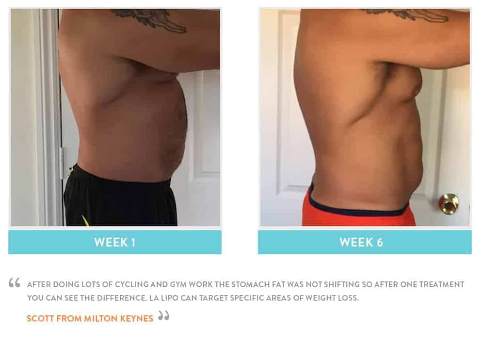 Before & After Stomach Fat Sutton on Trent