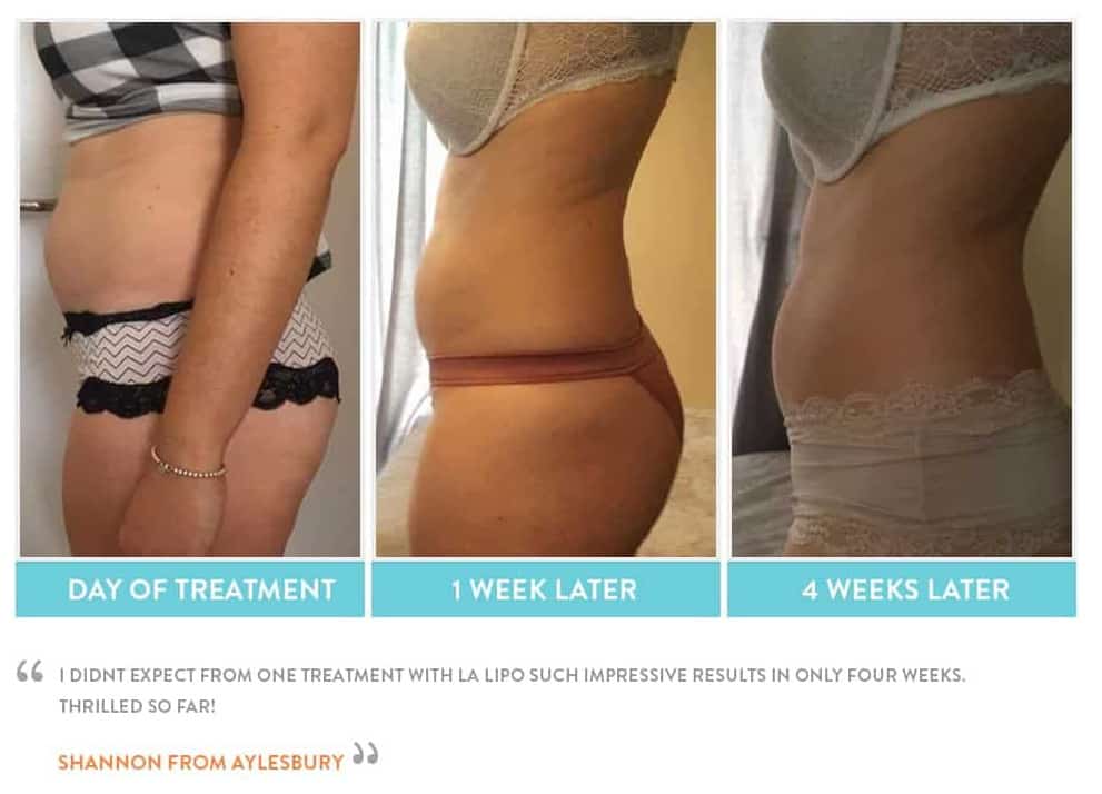 before, Cryolipolysis Sutton on Trent