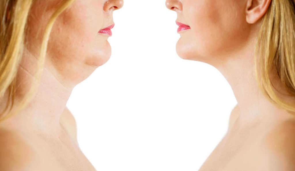 Double Chin treatment Sutton on Trent before and after results