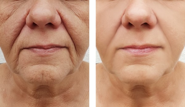 Learn more about Morpheus8 Treatment Sutton on Trent today!