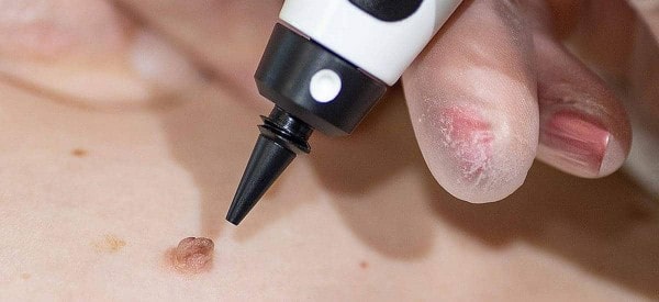 After Skin Tag Removal Sutton on Trent