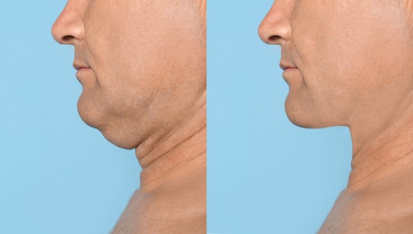 Which Non-Surgical Treatments Work Best for Jowls and Loose Skin Sutton on Trent?