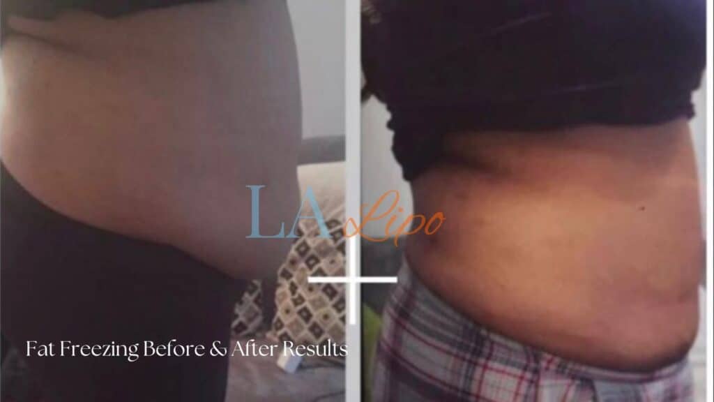 Before & After La LIPO