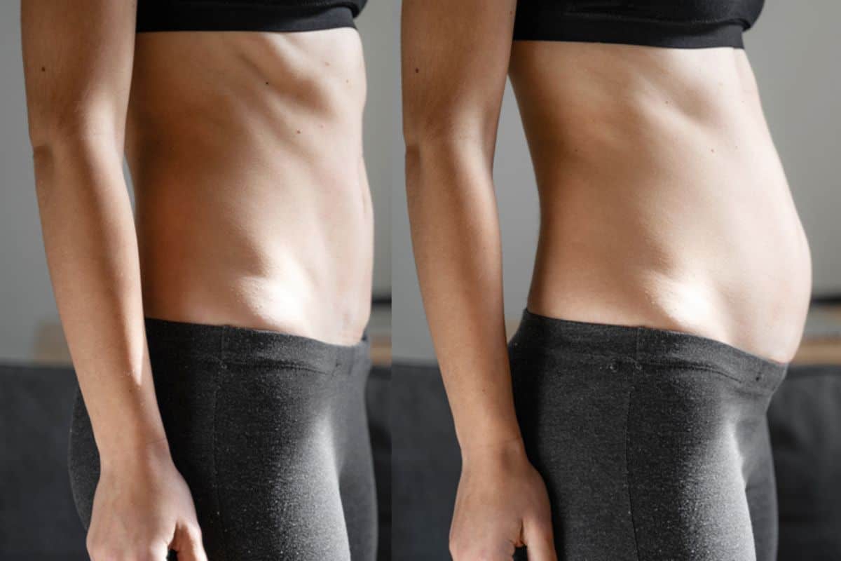 How long does diastasis recti take to improve Sutton on Trent?