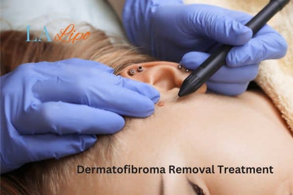 Dermatofibroma Removal Treatment Sutton on Trent
