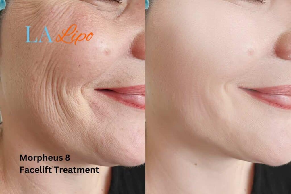 Morpheus8 Treatment Sutton on Trent for flawless skin! Call us today!