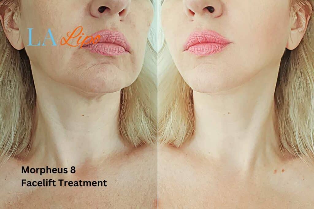 Turn back time with Morpheus8 Treatment Sutton on Trent