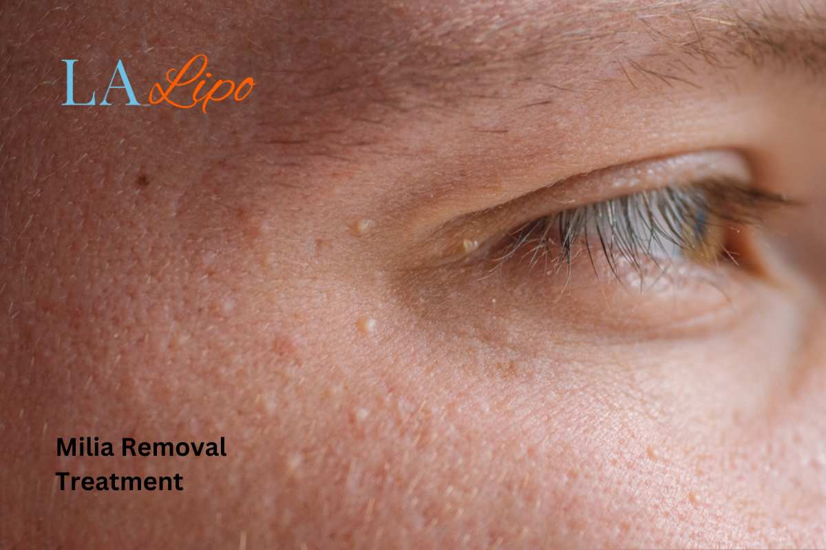 Cryopen Milia Removal: Is It the Easiest and Safest Option Sutton on Trent?