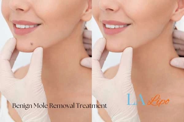Before-and-after results following benign mole-removal treatment Sutton on Trent