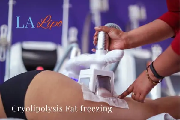 women getting fat freezing Sutton on Trent