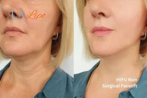 hi-fu for wrinkles Sutton on Trent before and after results