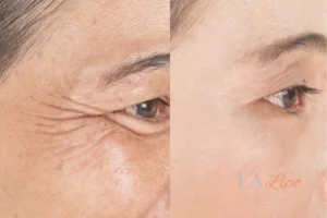Before and after results of woman - HI-fu wrinkles reduction treatment Sutton on Trent