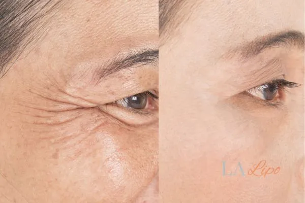 Before and after results of woman - HI-fu wrinkles reduction treatment Sutton on Trent