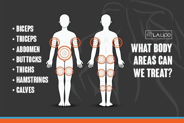 Graphic to show areas you can have LA-EMS Body Sculpting Sutton on Trent treatment.