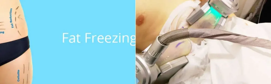 Fat freezing Sutton on Trent on multiple areas of the body