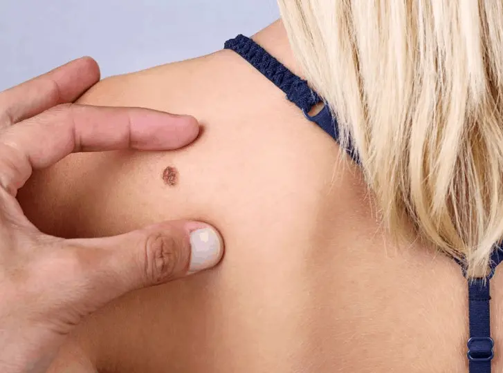 woman having mole removal Sutton on Trent consultation before treatment.