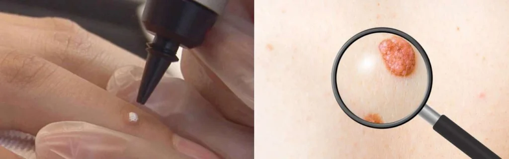 CryoPen practitioner Sutton on Trent assessing a benign mole before treatment