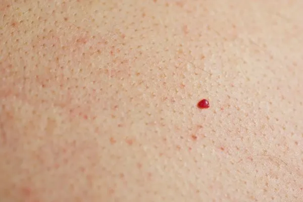close up of a cherry angioma Sutton on Trent