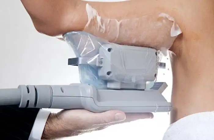 Picture of fat freezing Sutton on Trent on the upper arms.