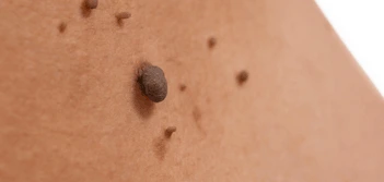 image of a skin tag Sutton on Trent