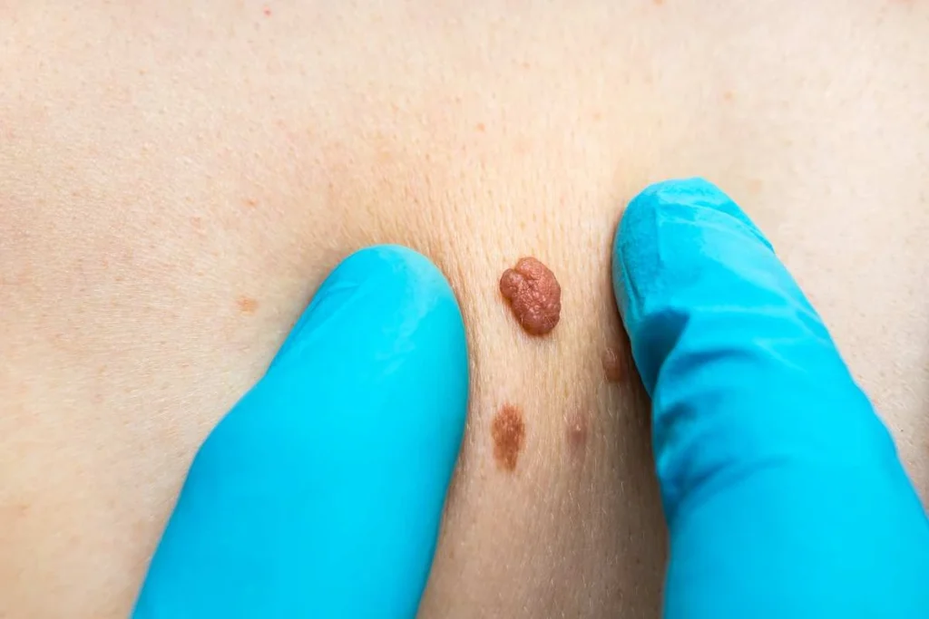 Consultant examining a skin tag Sutton on Trent