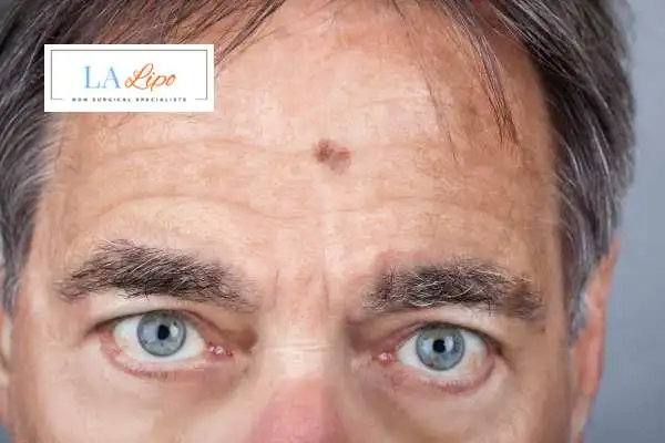 Solar Lentigo Removal Sutton on Trent image of man with mark on his forehead