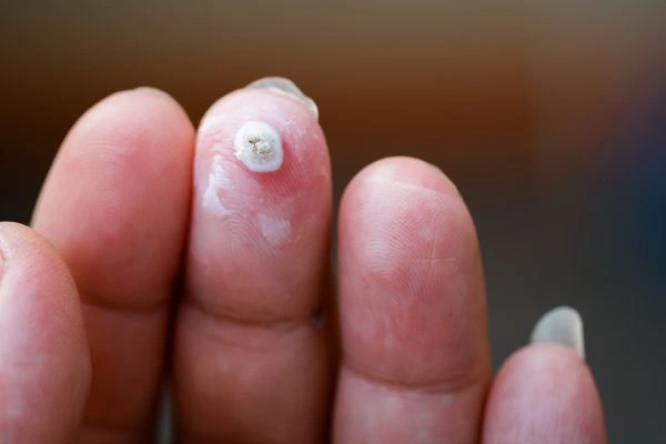 wart on person finger - cryotherapy to treat from LA LIPO Sutton on Trent