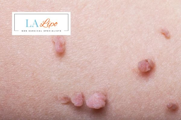 Does cryopen skin tag removal Sutton on Trent hurt? Find out now call our team today!