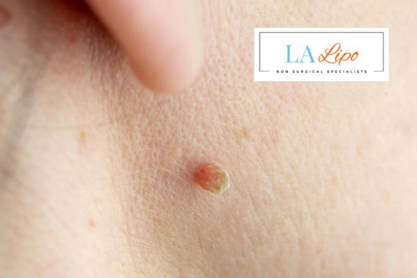 Book skin tag removal Sutton on Trent today speak to our team now!