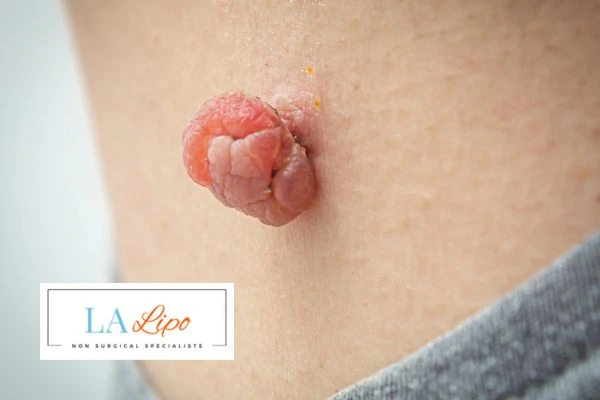 Interested in skin tag removal Sutton on Trent? Concerned about the pain? Find out more today!