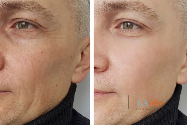See the amazing results of Morpheus8 Treatment Sutton on Trent!
