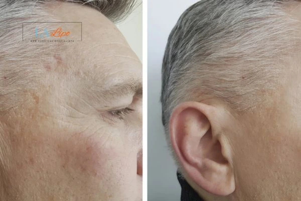 Mens Before & After Morpheus 8 Results Sutton on Trent