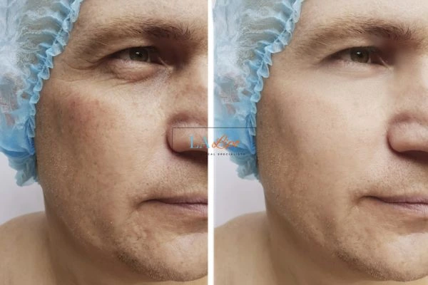 Before and after Morpheus 8 Results Sutton on Trent
