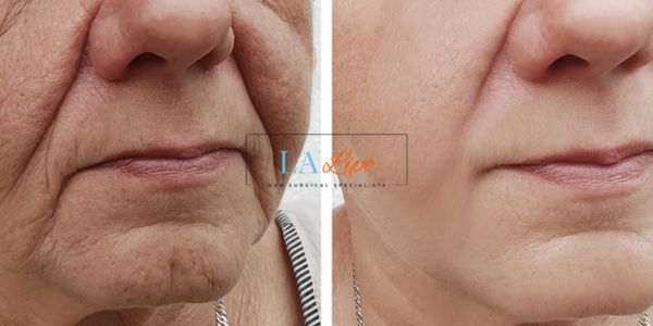 Older lady deeper wrinkle reduction - LA LIPO Morpheus 8 Results Sutton on Trent