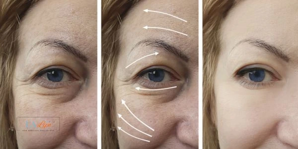 Amazing eye lift Morpheus 8 results Sutton on Trent