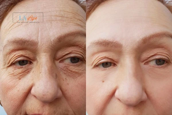 The powerful benefits of Morpheus8 Treatment Sutton on Trent - Call Our team today!