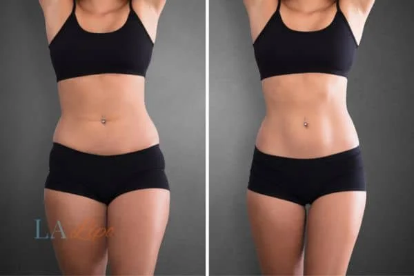 before and after results of non-surgical treatment to help a woman's body image and mental health Sutton on Trent