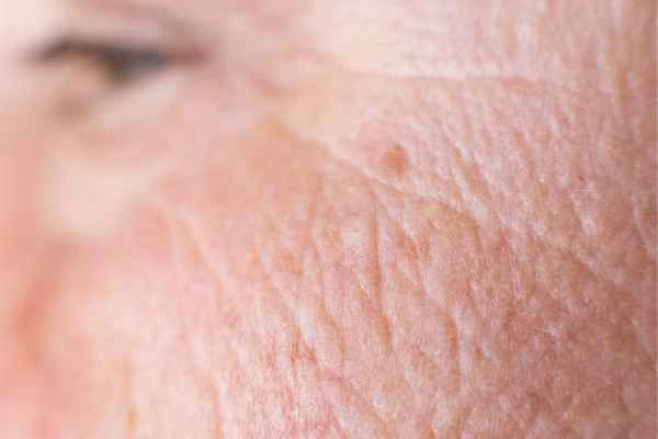 close up picture of a woman's face showing an age spot Sutton on Trent