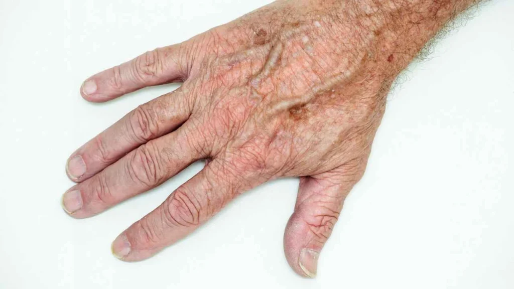Male hand showing age spot Sutton on Trent