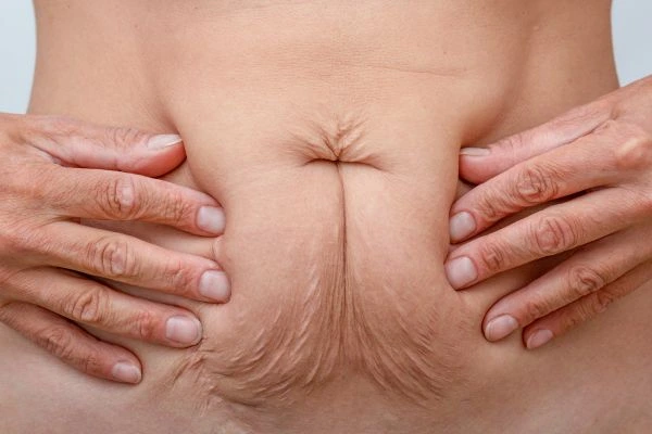 Image of a woman's stomach with loose skin - example of skin tightening Sutton on Trent options