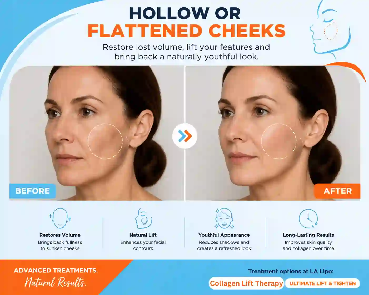 Sign #4: Hollow or Flattened Cheeks Sutton on Trent