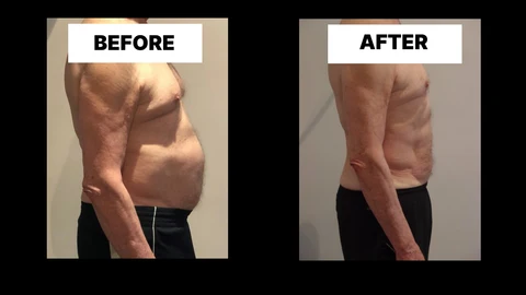 What Symptoms Can Diastasis Recti Cause in Men? Weak Core, Back Pain and Poor Posture Sutton on Trent